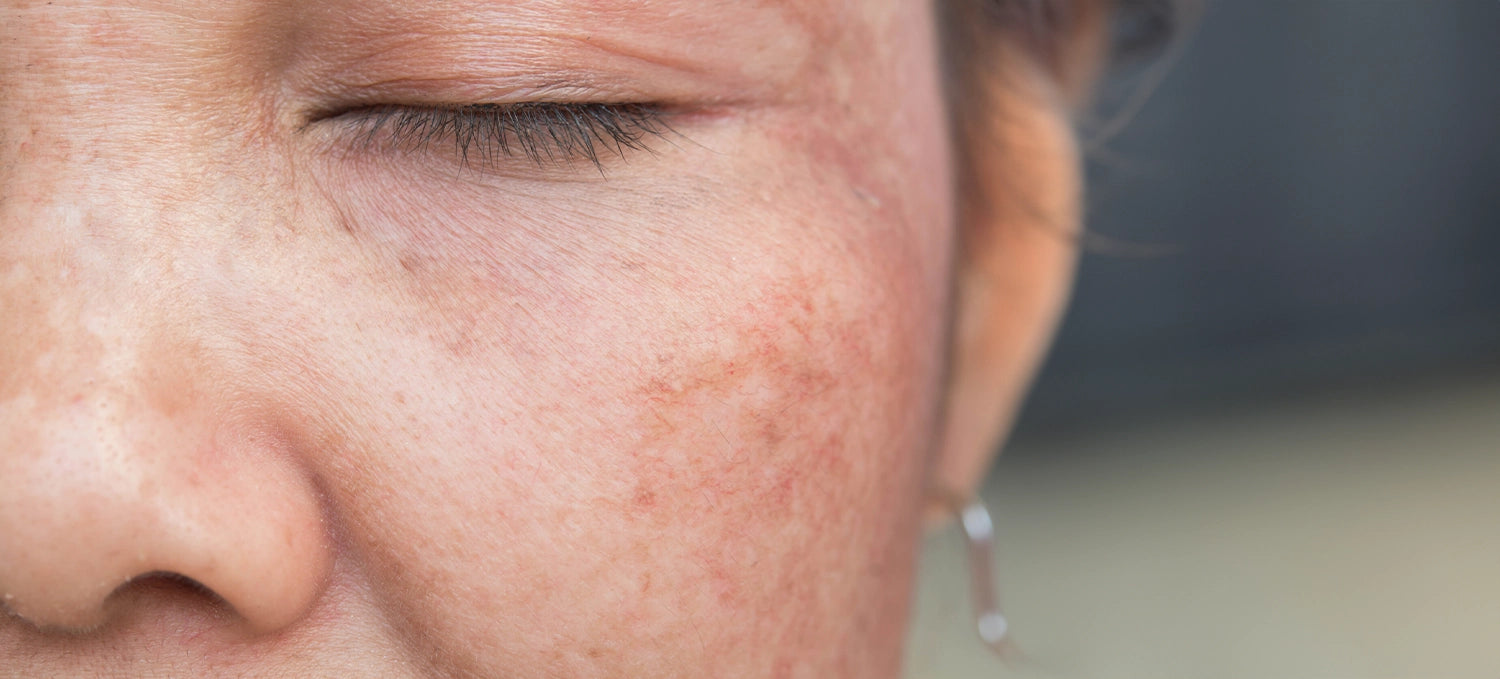 How to Prevent Dark Spots This Summer?